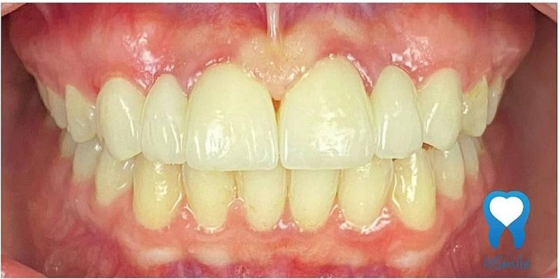 Hypodontia – After Hypodontia - After