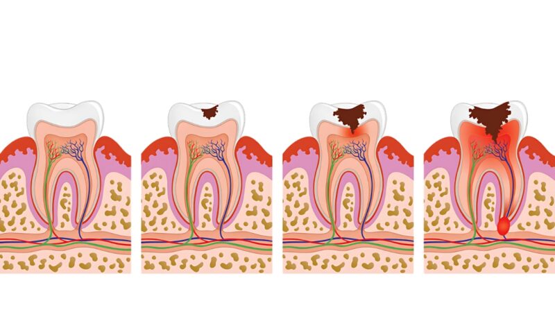 Tooth decay process Tooth decay process