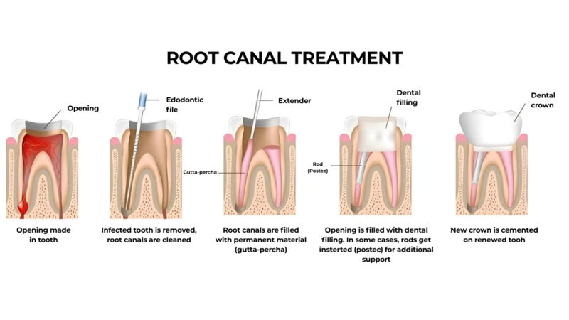 Root canal treatment Root canal treatment