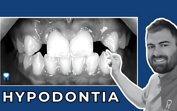 teeth-that-never-erupted-hypodontia-case-study