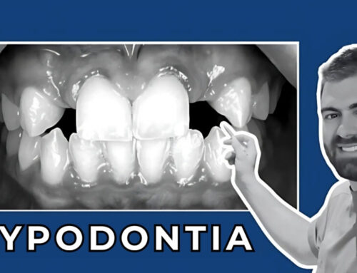 Teeth that never erupted – Hypodontia – Case study