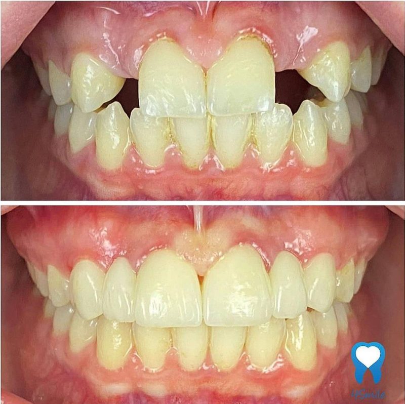 Hypodontia – Before and after Hypodontia - Before and after