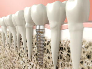 Dental implant Dental implant