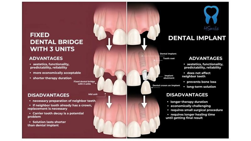 Advantages and disadvantages of dental implants and ceramic bridges