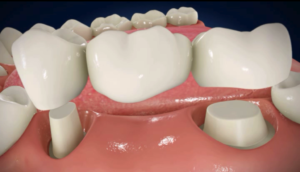 Dental Bridge Dental Bridge