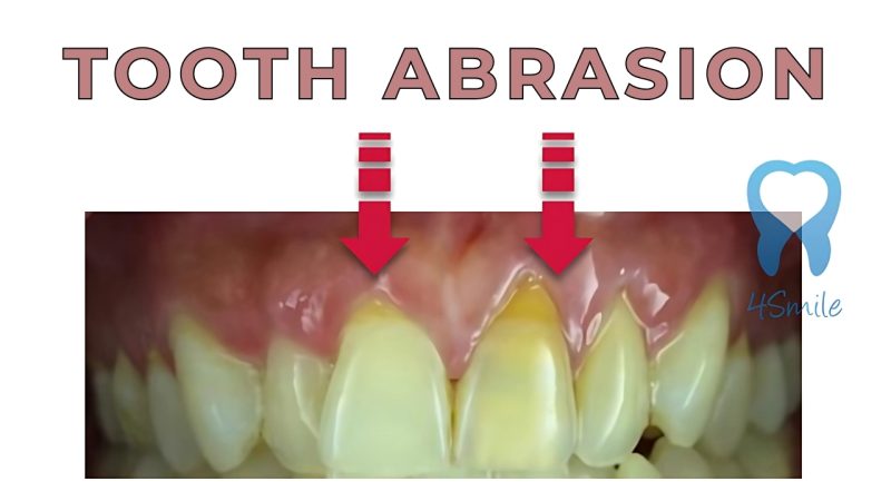 Tooth Abrasion