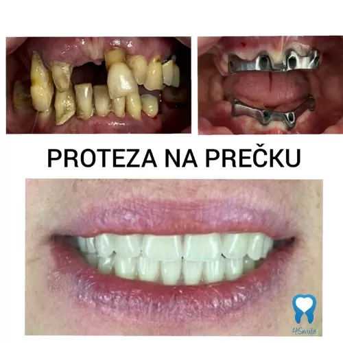 Polufiksna proteza na 4 implantata (proteza na prečki)