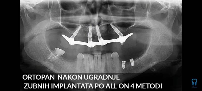 Ortopan nakon ugradnje ALL ON 4 - 4Smile
