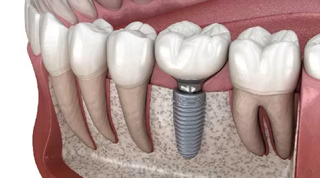 Zubni implantat