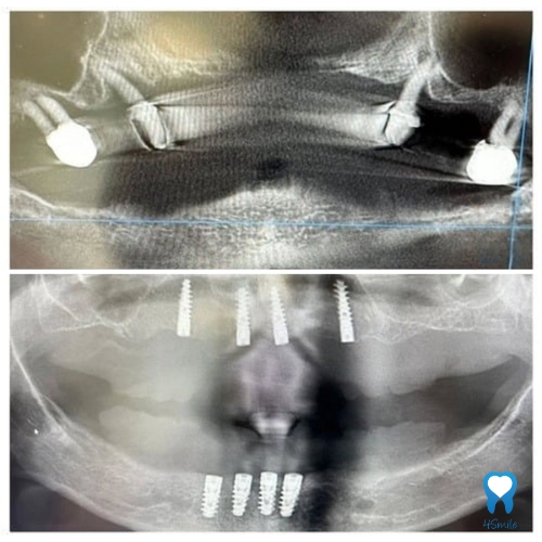 Ugradnja implantata - before/after