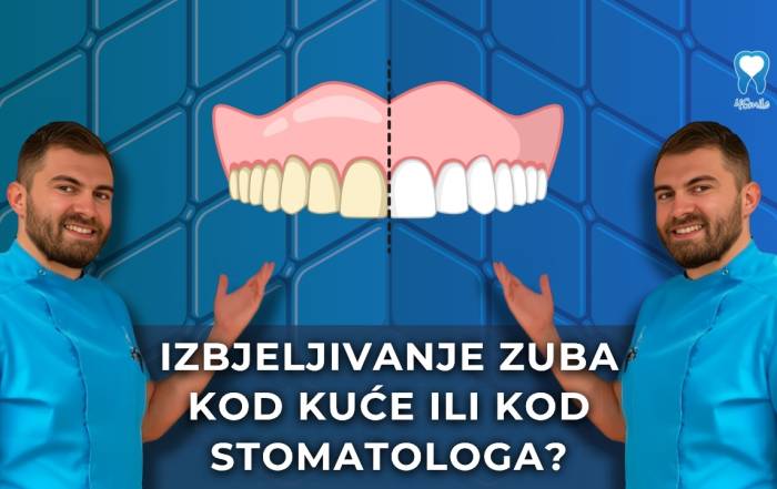 izbjeljivanje-zuba-kod-kuce-ili-kod-stomatologa-kratki-video-blog