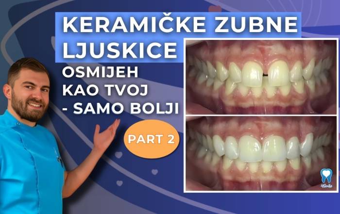 zatvaranje-dijasteme-bez-aparatica-keramicke-zubne-ljuskice