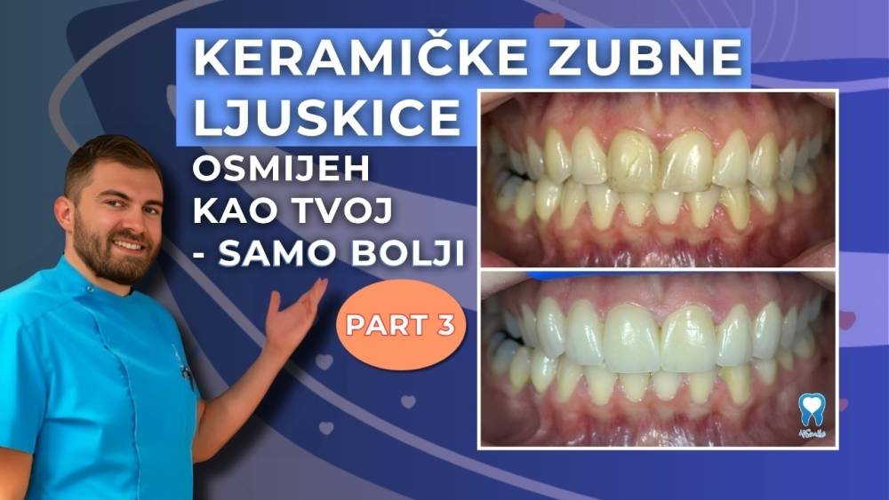 Keramičke zubne ljuskice zamjena za stare kompozitne ljuskice Keramičke-zubne-ljuskice-zamjena-za-stare-kompozitne-ljuskice