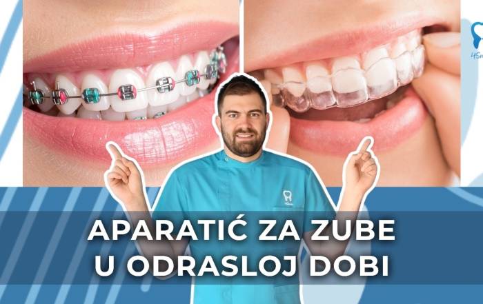 aparatic-za-zube-u-odrasloj-dobi-estetika-zdravlje-i-osmijeh-koji-traje