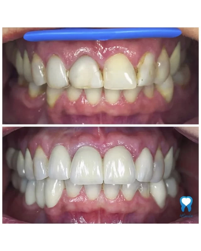 Elektrine cigarete - Utjecaj puenja na oralno zdravlje - 4Smile